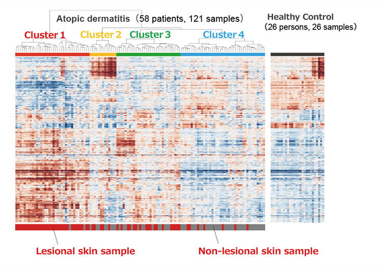 figure of Unsupervised clustering analysis of skin transcriptomic data identifies four clusters of AD patients