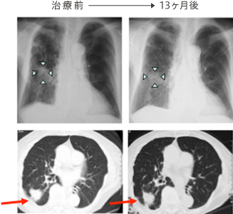 治療前と13ヶ月後の写真