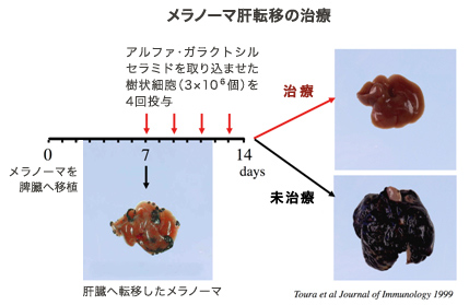 メラノーマ肝転移の治療の説明図